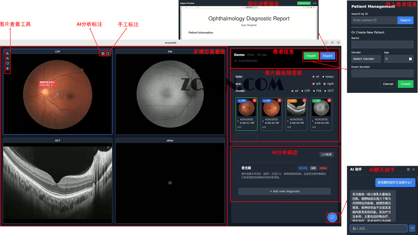 OcuAssist :AI辅助眼底多模态诊断系统,为眼科医生提供诊断支持
